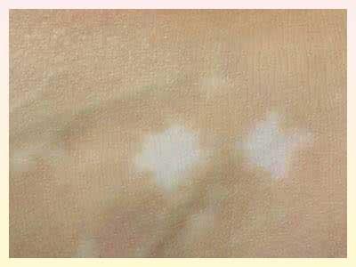 成都去哪治白癜风好?治疗白癜风时需要小心什么