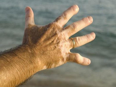 成都治疗白癜风去哪里?手脚患上白癜风怎么治疗好